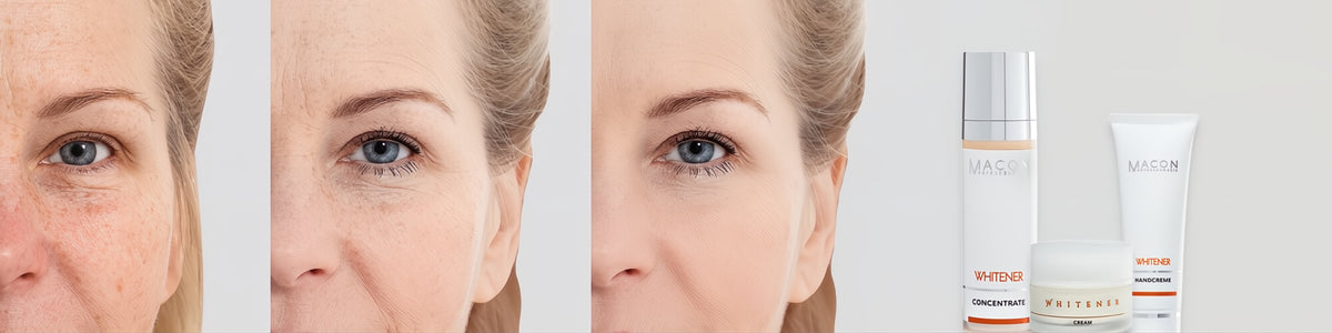 MACON Whitener Pigment Control Pflege gegen Pigmentflecken