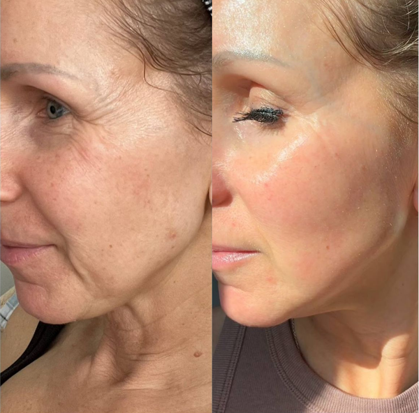 Before and after skin transformation